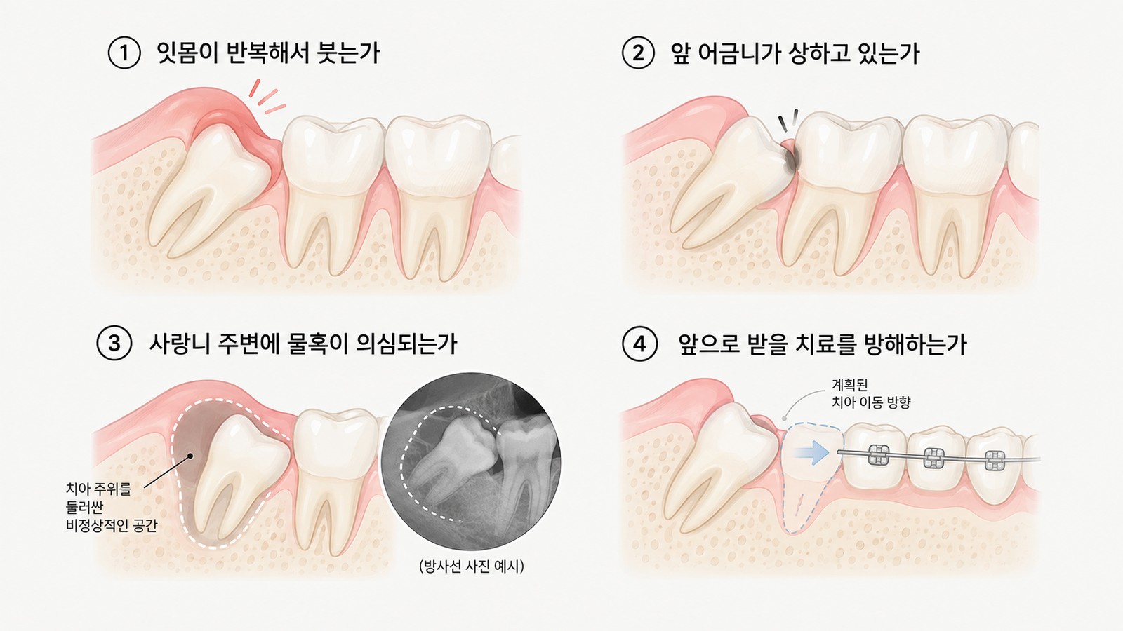 사랑니 발치 판단 기준 네 가지를 그린 그림 — 잇몸이 붓는 모습, 앞 어금니가 상한 모습, 물혹이 의심되는 부위, 교정 장치로 치아를 옮기는 방향